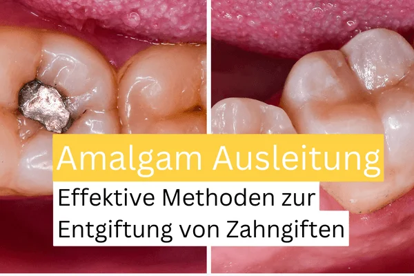 Amalgam Ausleitung